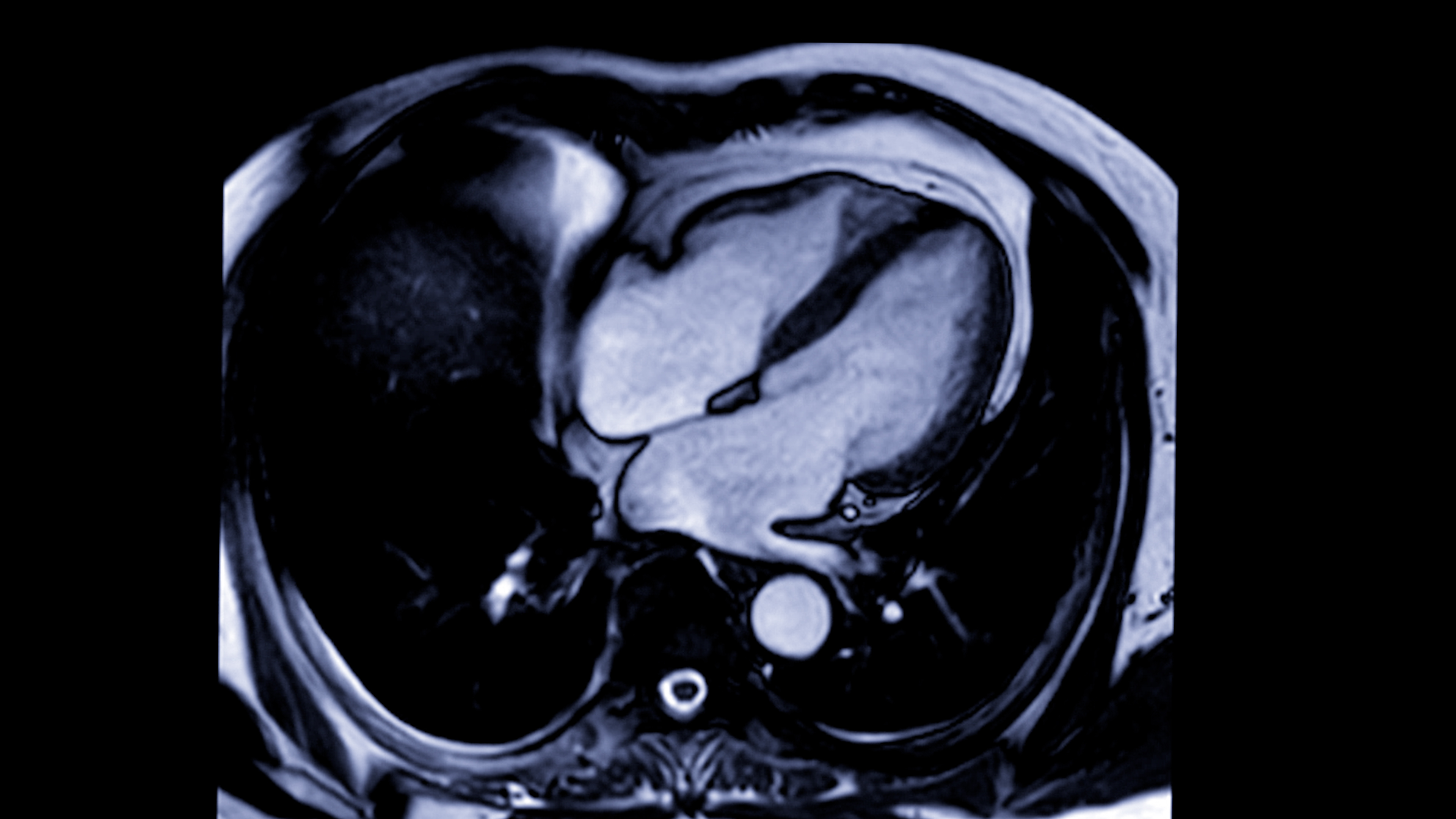 Cardiac MRI four-chamber view